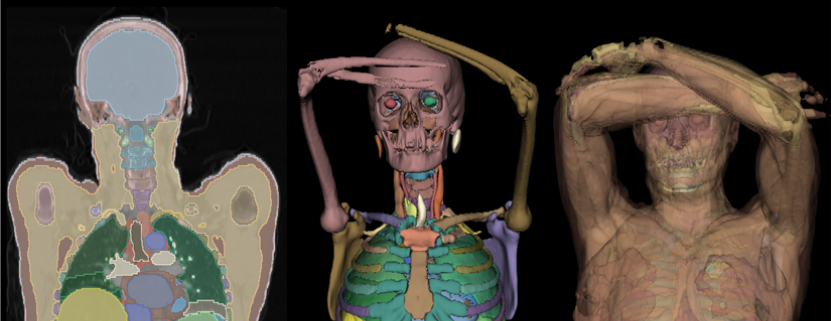 DAP-Atlas sample: a labeled coronal CT slice next to two 3D renderings — bones and organs, and the full body