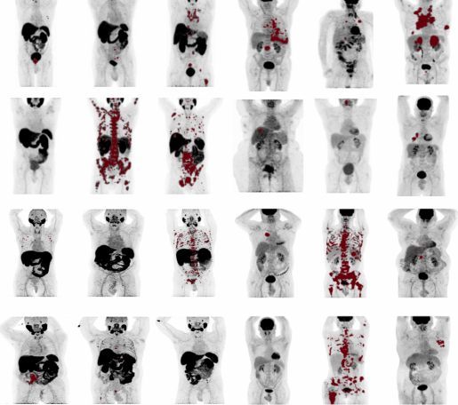 Representative test cases from the autoPET3 challenge illustrating the core difficulty: wide variation in disease extent (single lesion to high metastatic burden) and tracer-specific uptake patterns across PSMA (left) and FDG (right) scans from two centers.