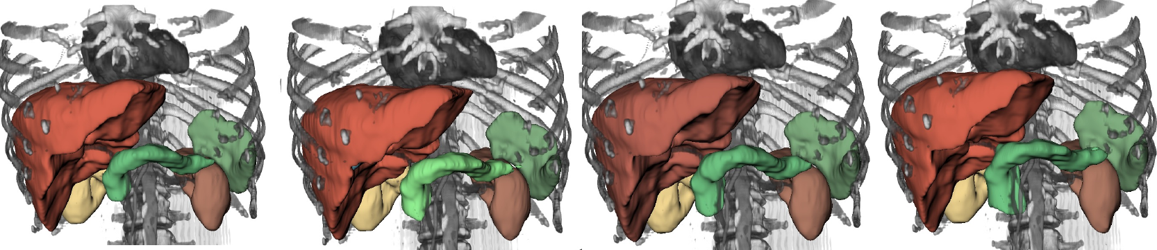 The same abdominal CT scan segmented by four different automated pseudo-labelers (one per panel) — each a plausible but visibly different labeling of the liver (red), kidneys (yellow and brown), pancreas (dark green), and spleen (light green). This annotator disagreement is exactly the label-quality variation the paper studies.